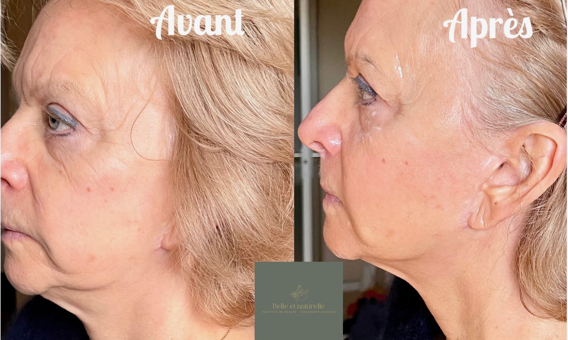 Avant et après une première séance de radiofréquence visage avec des soins naturels et bio à l’institut Belle et Naturelle. Résultat : peau plus lisse, lumineuse et tonifiée.