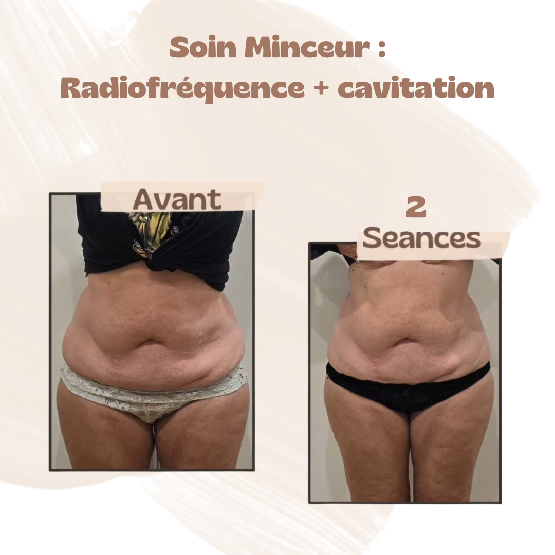 Résultat après deux séances de radiofréquence + cavitation : perte de centimètres, peau plus lisse, plus ferme grâce aux soins naturels