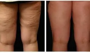 Résultat après six séances de radiofréquence + cavitation + pressothérapie + lipolaser + produits naturels : Diminution de la cellulite,  perte de centimètres, peau plus lisse, plus ferme grâce aux soins naturels