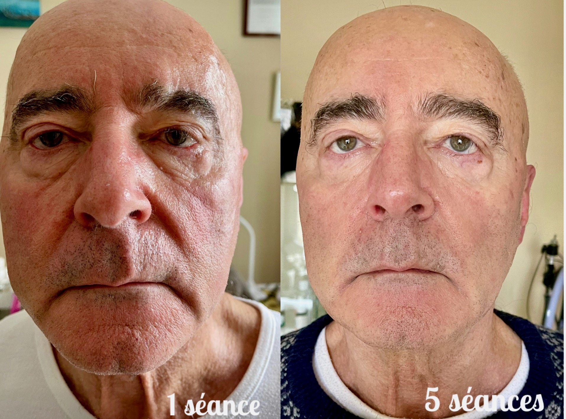 Avant et après 5 séances de radiofréquence visage avec des soins naturels et bio à l’institut Belle et Naturelle. Résultat : peau plus lisse, lumineuse et tonifiée.